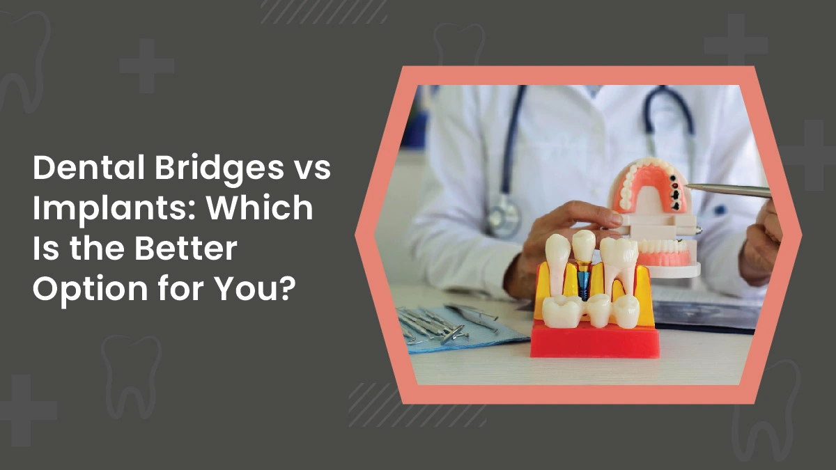 Dental Bridges vs Implants: Which Is the Better Option for You?